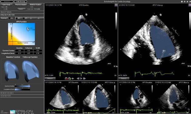 AMA Assigns New Investigational CPT Code for Myocardial Strain